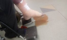 Stan nogi Krzysztofa pogarszał się z każdą minutą / Fot. Anna Siwecka Stan nogi Krzysztofa pogarszał się z każdą minutą / Fot. Anna Siwecka